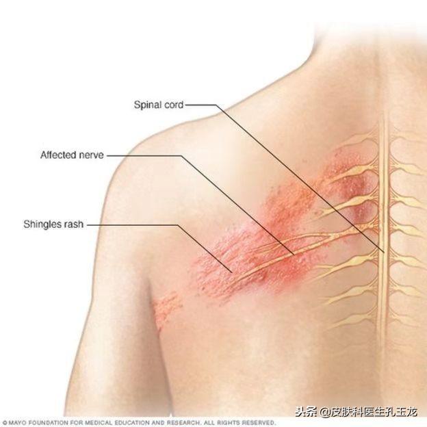 八种疱疹的图片（皮肤科常见疾病系列：疼痛难忍的带状疱疹）(图3)