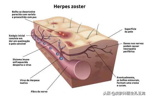 八种疱疹的图片（皮肤科常见疾病系列：疼痛难忍的带状疱疹）(图2)